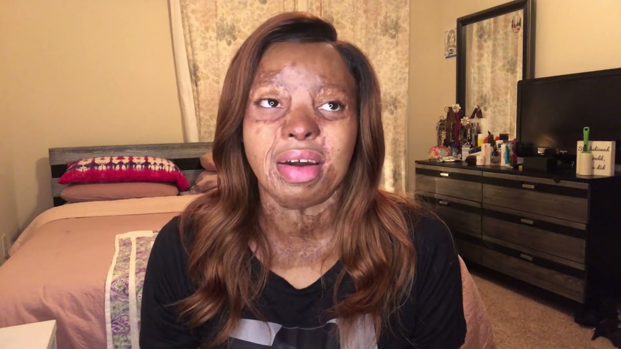 Plane Crash Survivor Kechi Okwuchi  Grossman Burn Foundation