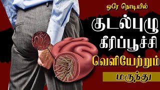 குடல் புழு | கீரிப்பூச்சி தீர்வுகள் என்ன ?ஒரே நொடியில் வெளியேற்றும் மருந்து