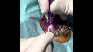 MicroPulse® transscleral laser therapy (TLT) with CYCLO G6