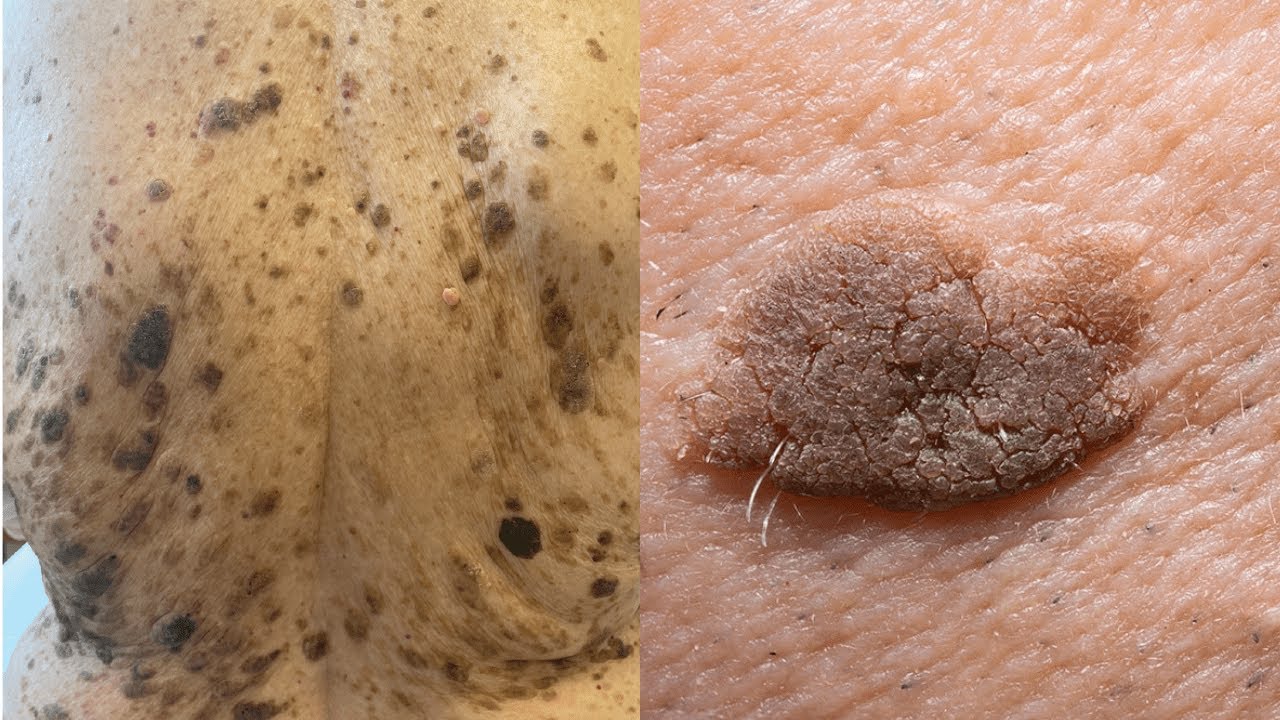 seborrheic-keratosis-treatment-symptoms-causes-risk-factors-vs