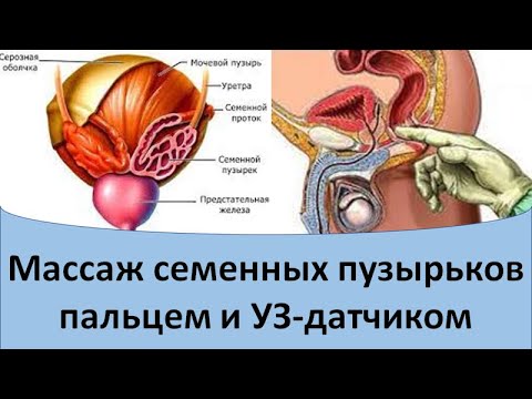 Массаж семенных пузырьков пальцем и УЗ датчиком