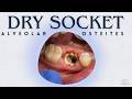Dry Socket Explained | The Most Common Extraction Complication and Its Managment