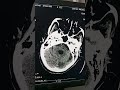 scanner cérébral ( AVCI occipital temporal ) #shorts #tdm #scanners