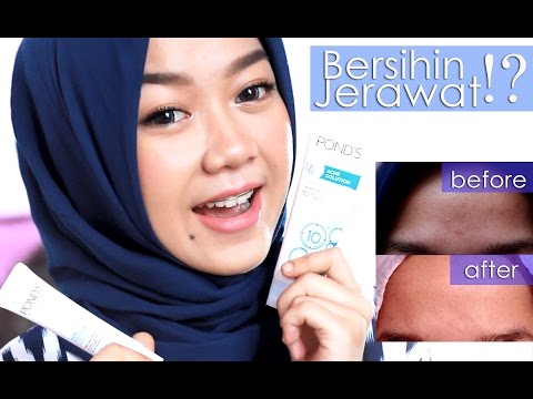 Jerawat Hilang Dalam 3 Hari Ponds Acne Solution Cheryl Raissa