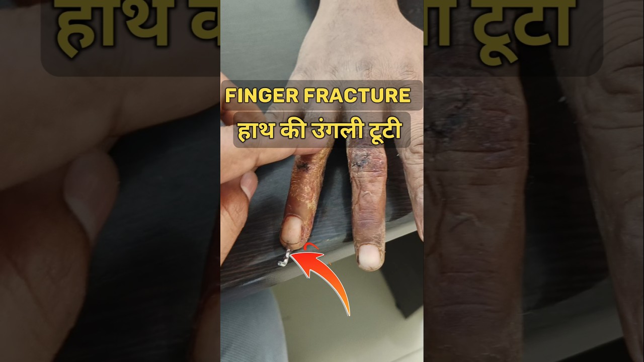 Finger Fracture K-Wire 🔥 हाथ की ऊंगली में फ्रैक्चर 