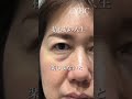 【眉下切開リフト/クマ取り】ママ、綺麗になるね #shorts