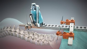 Robotic Assisted Spine Surgery Animation