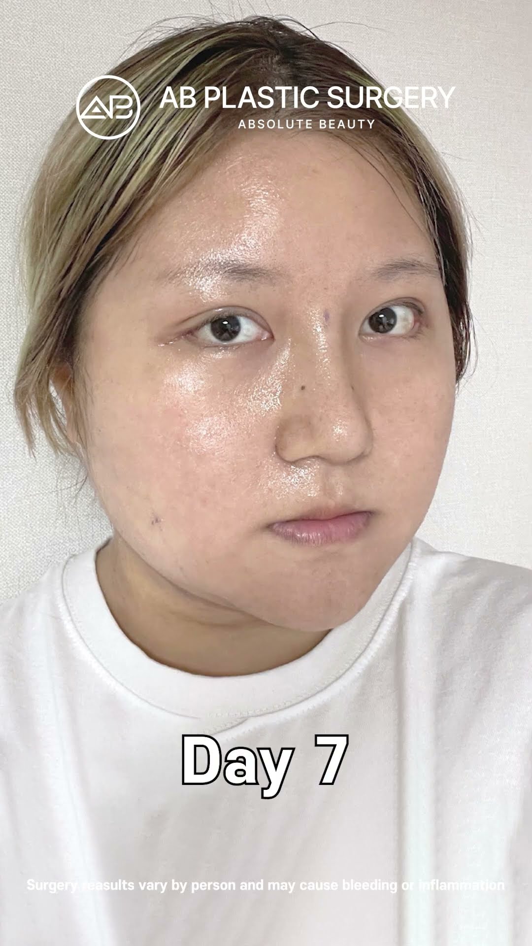[MAKE ME Girl] Full Journey: Double Eyelid, Eye Correction, Nose & Contouring #shorts