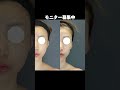 顔のコケを頬脂肪注入で改善！？#shorts