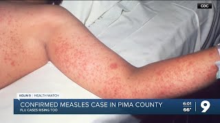 Measles confirmed in Pima County and flu’s on the rise too