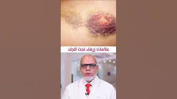 ظهور علامات زرقاء على الجسم وعلاقتها بمرض القلب 