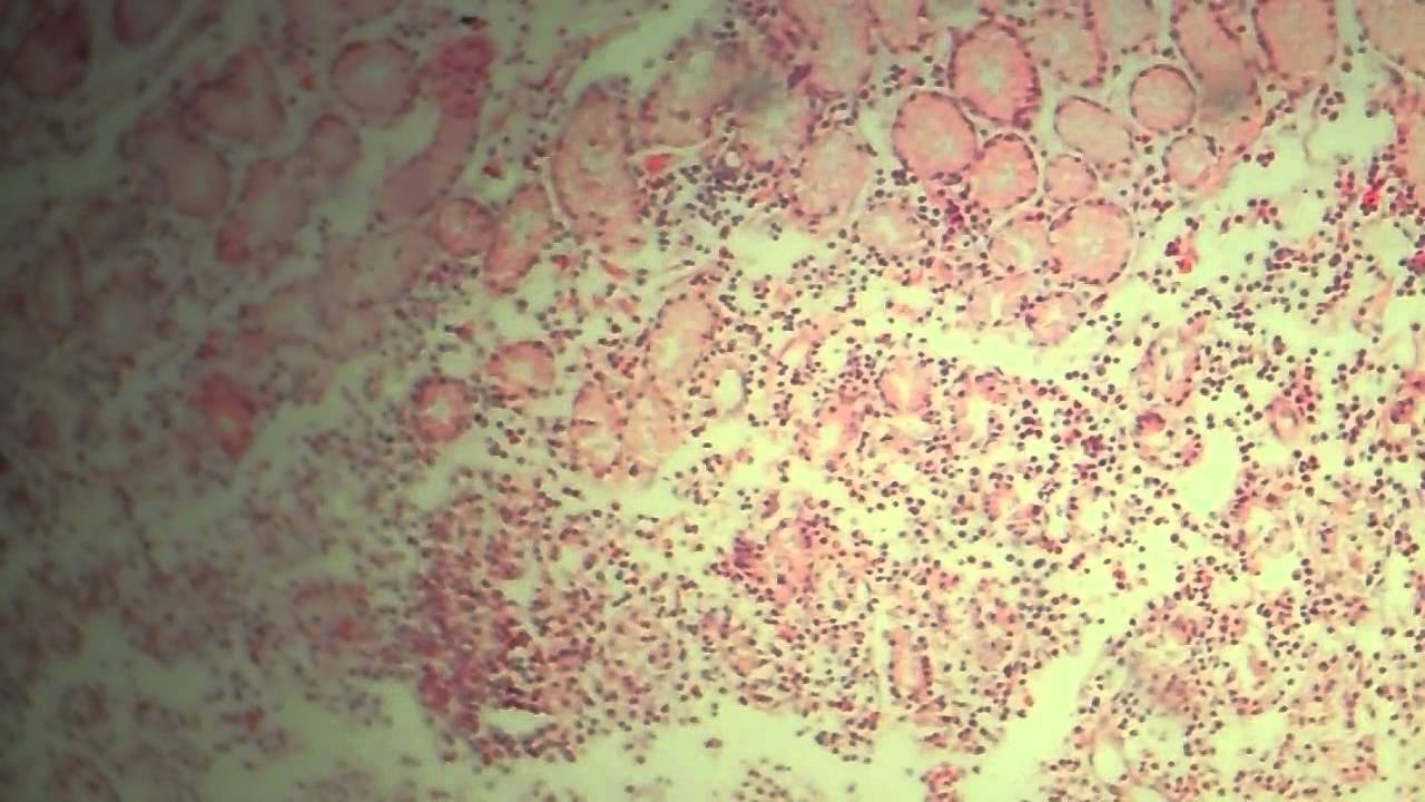 Cronica gastritis moderada inactiva antral