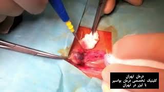 جراحی بواسیر خارجی - درمان تهران