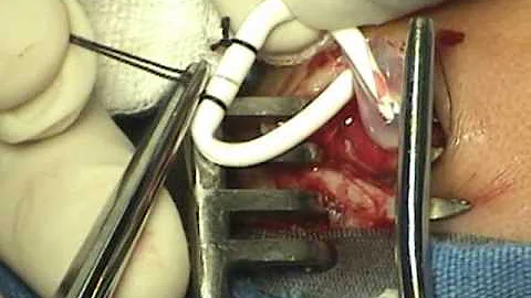 Quais os riscos da cirurgia da hidrocefalia?