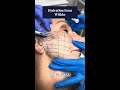 Hydration from within with skinbooster