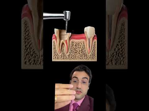 “Ai, vai estragar dois dentes pra colocar um”