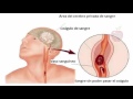 6 Importantes síntomas que alertan un derrame cerebral y cómo prevenirlo