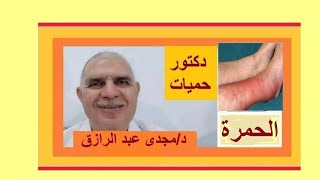 مرض الحمرة بالساق أسبابها ومضاعفاتها وعلاجها معلومات عامه عن الطب erysipelas -cellulitis