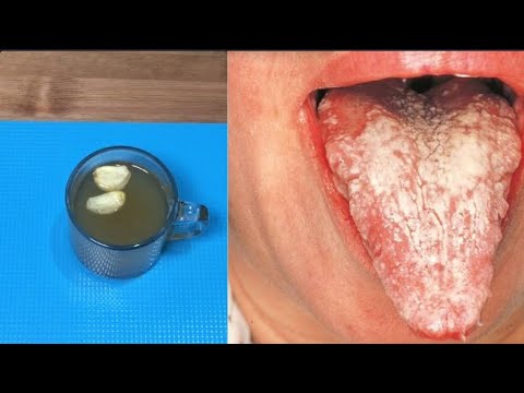 Get rid of candida fungus with garlic tea! Try this tea.