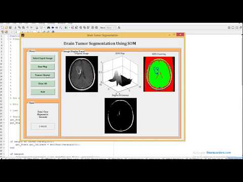 MATLAB code of Brain tumor Detection using SOM detection, Segmentation, and watershed Transform.