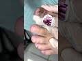 Ep_5430 Ingrown toenail removal 👣 สงสารน้องจัง..เล็บผิดรูป และเป็นแผล 😊 (clip from Thailand)