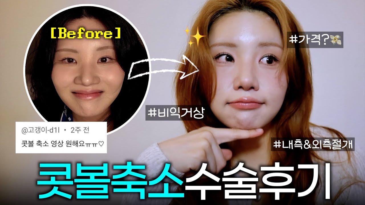 티 안 나게 예뻐지는 수술✨ 콧볼축소수술 반년 차의 자세한 후기 (feat. 과정영상, 부작용)