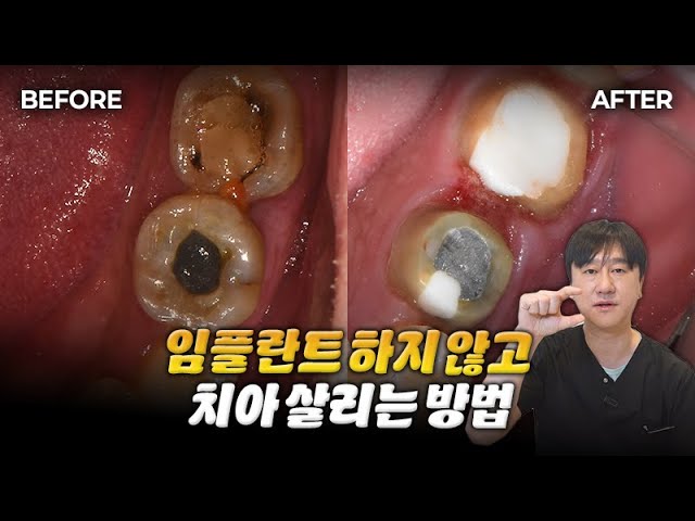치아 깨졌을때 치료방법 | 임플란트, 보철치료 (Feat.얼음먹다 깨짐💥)