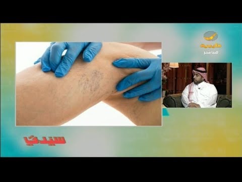 المرأة الأكثر إصابة بدوالي الساقين من الرجل هل هناك علاج