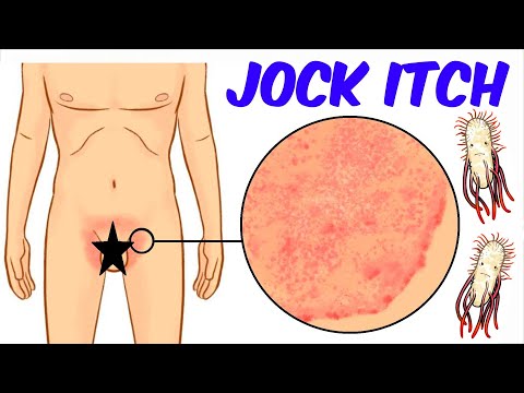 Vidéo: Est-ce Que Jock Itch Est Contagieux? Par Le Sexe, Aux Femmes Et Plus