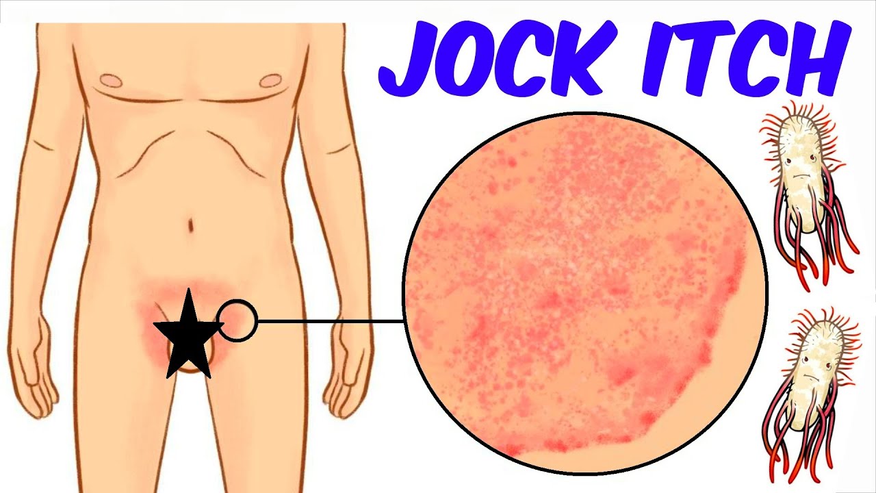 How to Cure Jock Itch