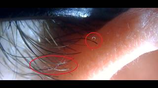 Worms crawling up hair shafts human head  parasites 240 frames per second low res 640 x 360
