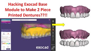 2 Piece Digital Dentures in Exocad Without the Denture Module!
