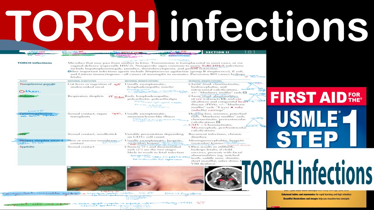 TORCH infections in Hindi/Urdu by first aid for USMLE step 1 - YouTube
