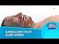 Sleep Apnea Ganggu Tidur, Waspada Gagal Jantung mengintai