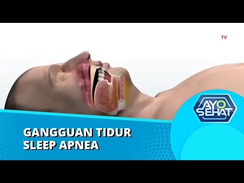 Video: 5 Cara Menyembuhkan Apnea Tidur