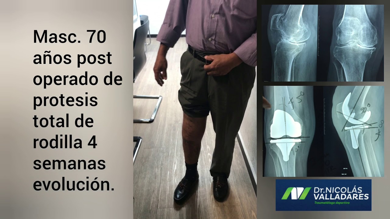 En Cuanto Puedo Caminar Normal Despu s De Una Pr tesis De Rodilla en-cuanto-puedo-caminar-normal-despu-s-de-una-pr-tesis-de-rodilla
