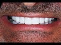 Video Procedure of Dental Veneers after Invisalign at Cosmetic Dental Associates