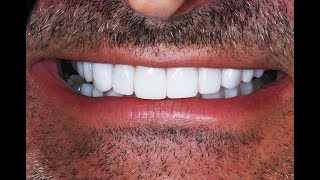 Video Procedure of Dental Veneers after Invisalign at Cosmetic Dental Associates