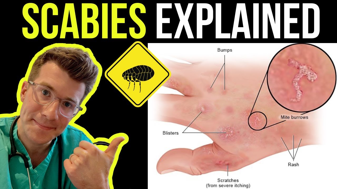 Doctor explains SCABIES skin rash, including SYMPTOMS, PHOTOS OF SKIN,  TREATMENT & more 