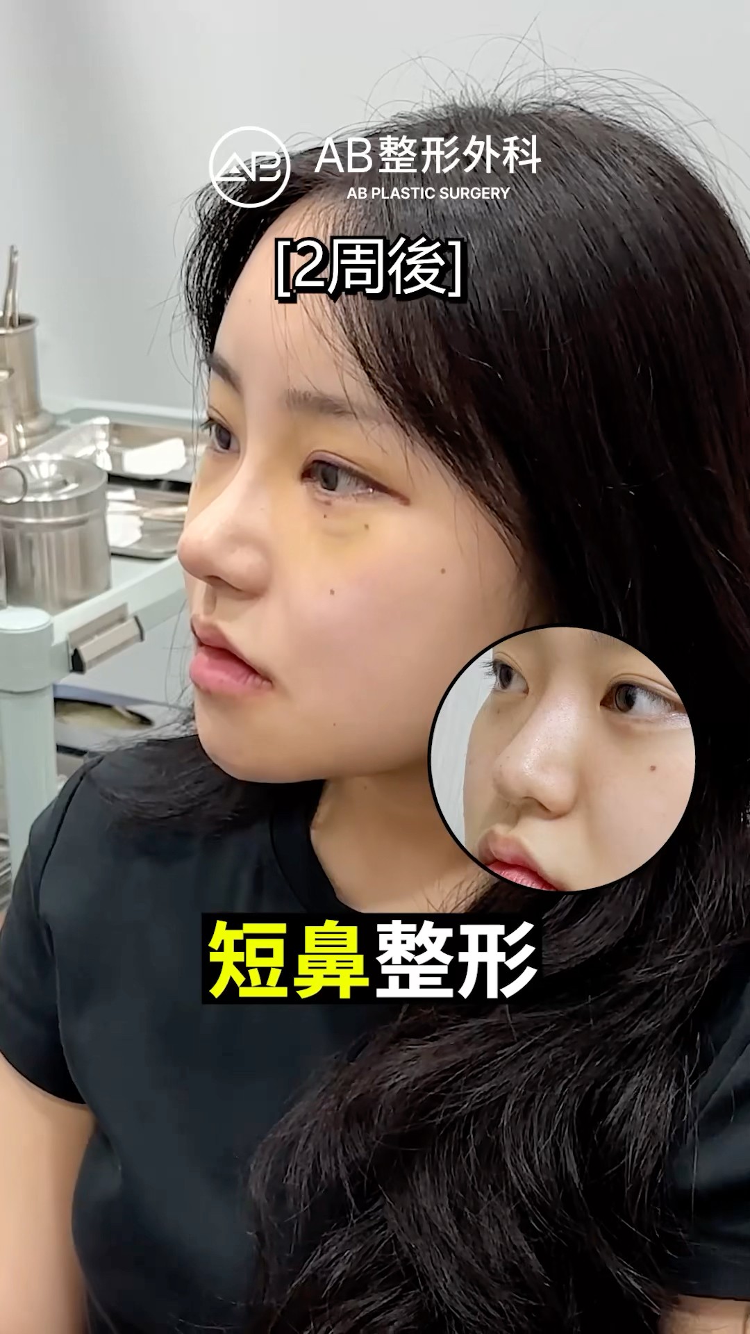 2 週成效公開｜鼻整形前後差異超明顯！ #shorts