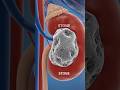 Kidney Stone Formation | Inside the Kidney: Stone Formation in 3D | Human Kidney Stones Animation