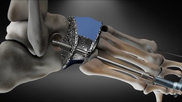Charcot Foot Implant surgery 3D animation