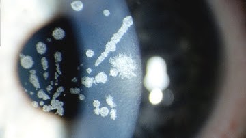 MNEMONIC - Corneal Stromal Dystrophy!