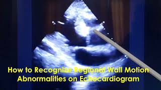 How to Recognize Regional Wall Motion Abnormalities on Echocardiogram?
