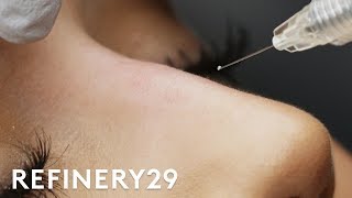 Why I Got This 15 Minute Nose Job | Macro Beauty | Refinery29
