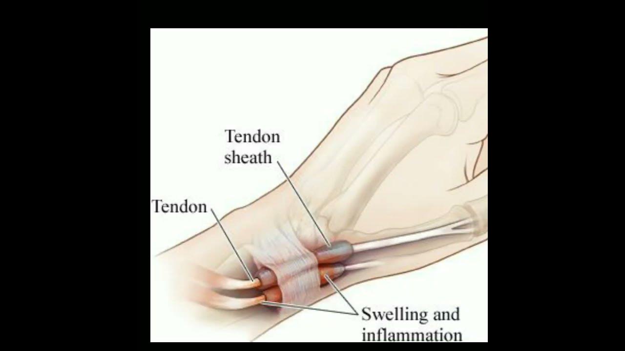 Болит запястье при нагрузках. Тендовагинит де Кервена кисти. Тендовагинит сухожилий кисти руки. Тендовагинит лучезапястного сустава. Тендовагинит правого лучезапястного сустава.
