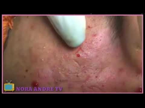 blackhead (remove) get rid of pimples on the forehead--rimuovere il comedone