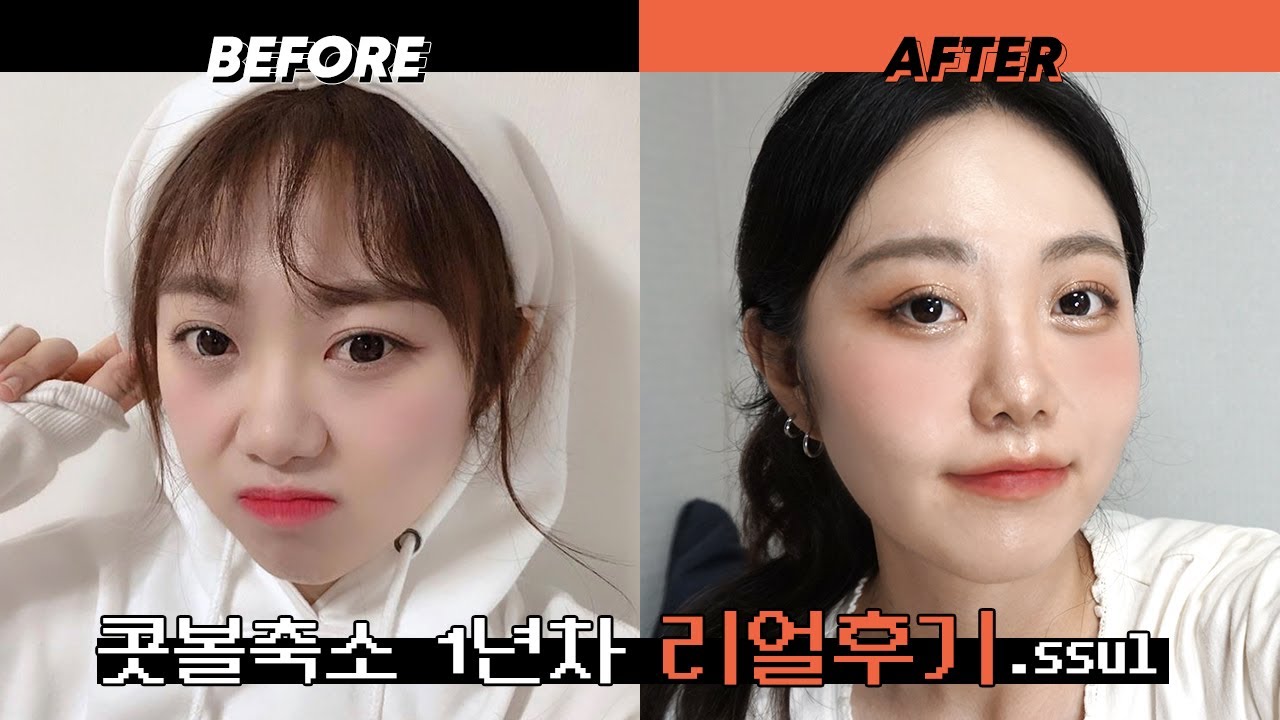 쫄보의 다사다난 콧볼 축소 수술 1년차 리얼 찐 후기 | 수술썰, 흉터, 붓기, 실밥, 회복기간,  복코, 왕코, 지방형복코