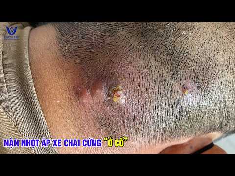 Mụn Gáy Không Xử Lý Sớm Cái Kết Là Ổ Viêm Khổng Lồ.