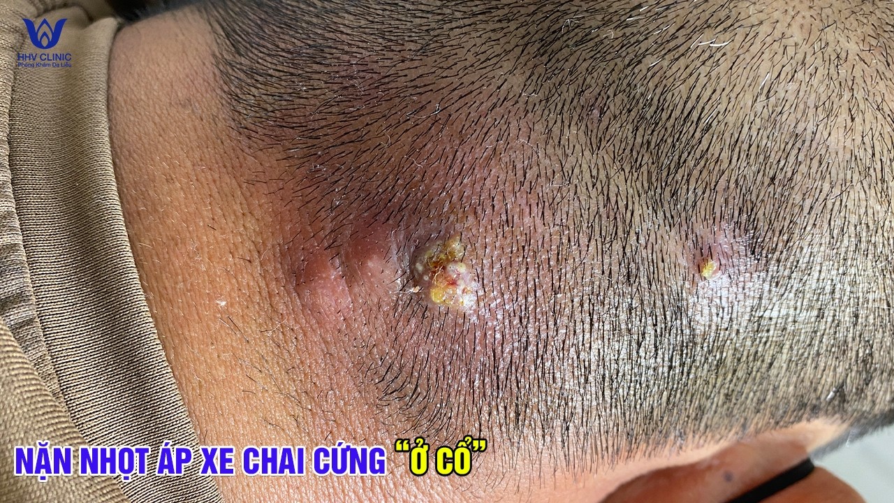 Mụn Gáy Không Xử Lý Sớm Cái Kết Là Ổ Viêm Khổng Lồ.